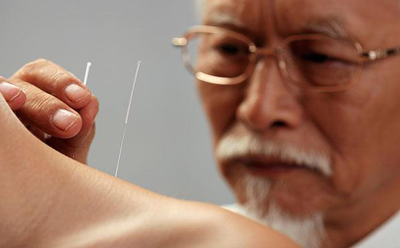 中国的研究人员发现, 正确施用针灸治疗能够减轻最常见的偏头痛